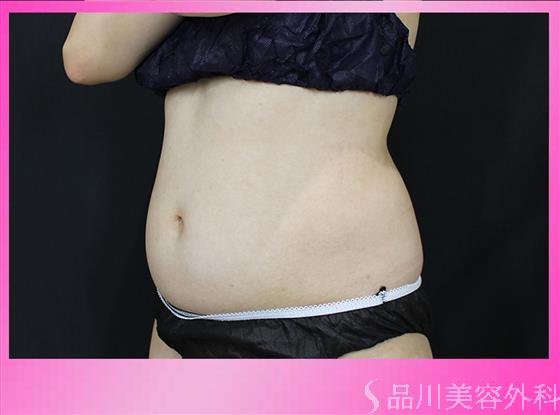 症例NO.50033のBEFORE写真