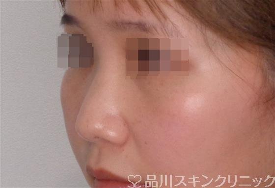 症例NO.50308のBEFORE写真