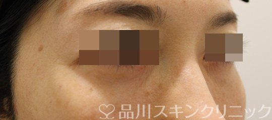 症例NO.68692のAFTER写真