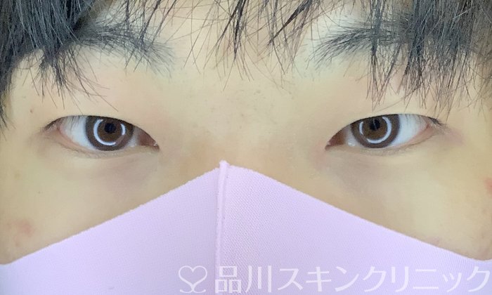 症例NO.65385のBEFORE写真