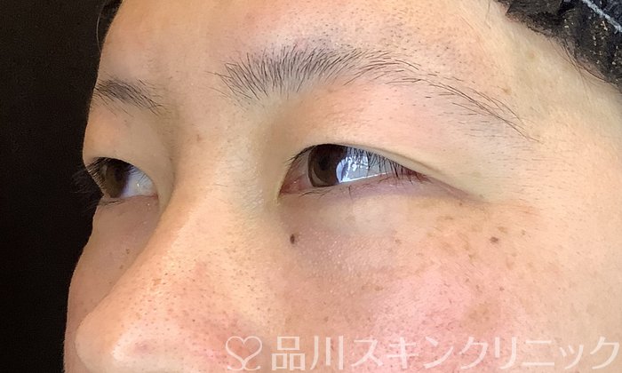 症例NO.67190のBEFORE写真