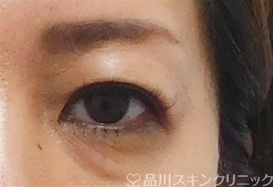 症例NO.51091のAFTER写真