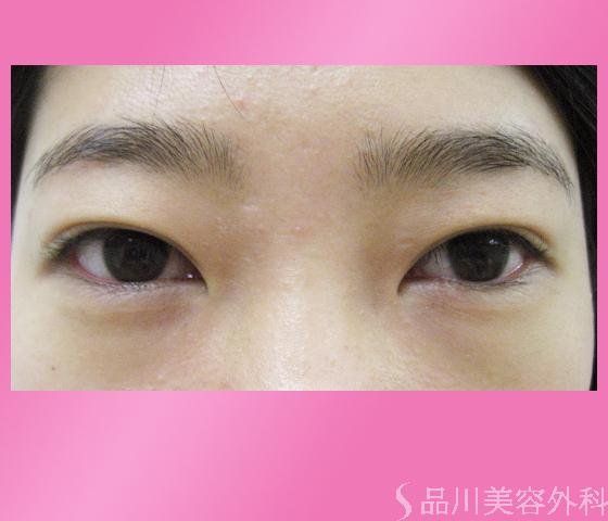 症例NO.2185のBEFORE写真