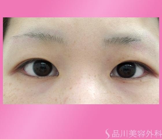 症例NO.1111のBEFORE写真