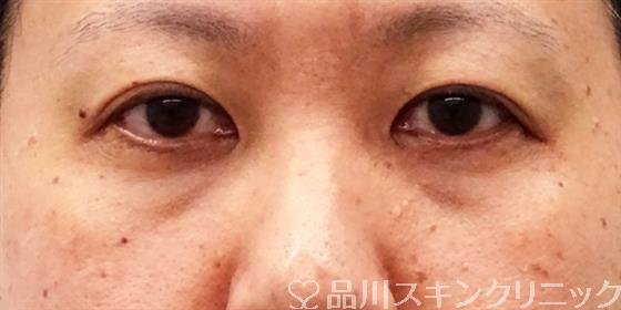 症例NO.51641のBEFORE写真