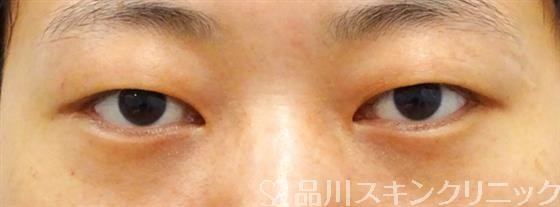 症例NO.48743のBEFORE写真