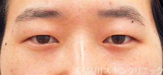 症例NO.53400のBEFORE写真