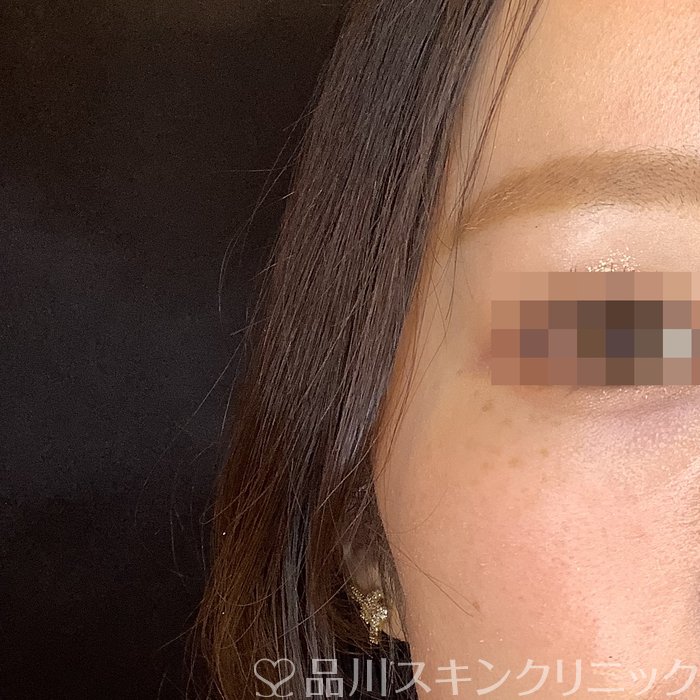 症例NO.64870のBEFORE写真