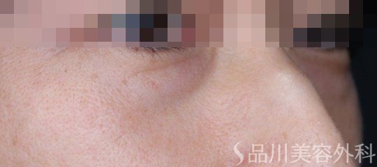 症例NO.67690のBEFORE写真