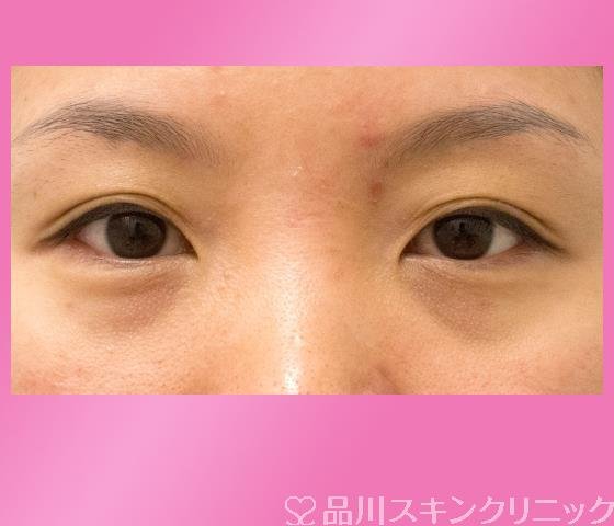 症例NO.27221のBEFORE写真