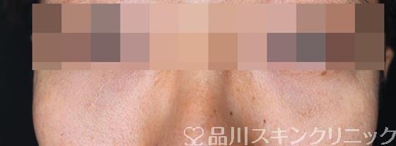 症例NO.54024のAFTER写真