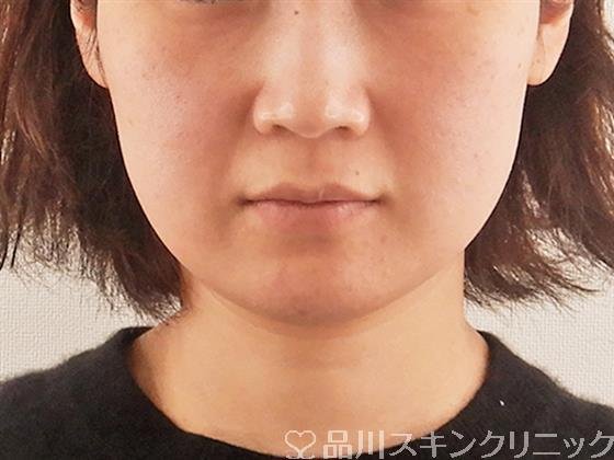 症例NO.57872のBEFORE写真