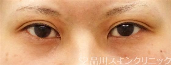 症例NO.50205のBEFORE写真