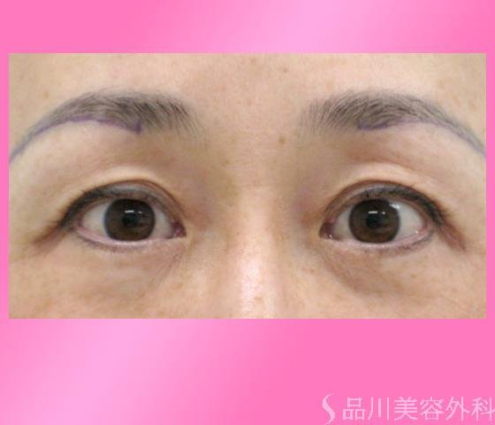 症例NO.1808のBEFORE写真