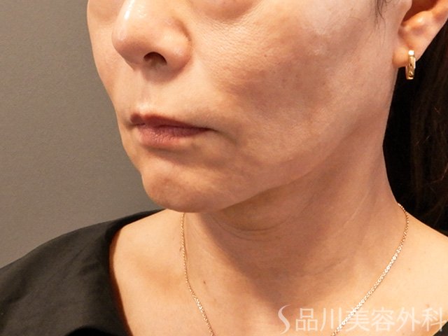 症例NO.67191のBEFORE写真