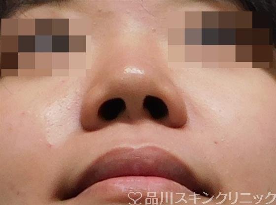 症例NO.49695のBEFORE写真