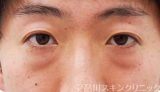 症例NO.59246のBEFORE写真