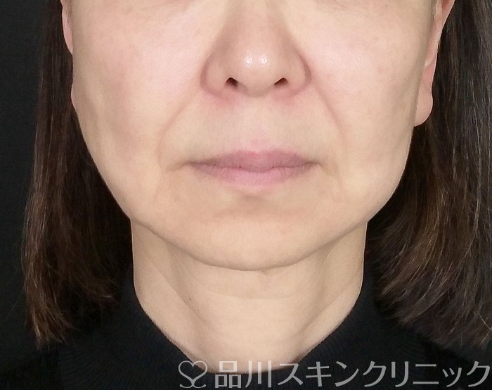 症例NO.63609のBEFORE写真