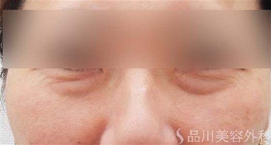 症例NO.61165のBEFORE写真