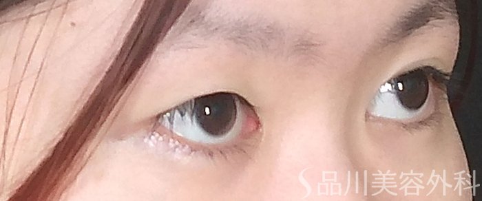 症例NO.69087のBEFORE写真