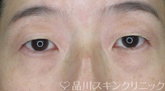 症例NO.68103のBEFORE写真