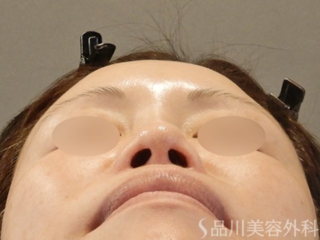 症例NO.65779のBEFORE写真