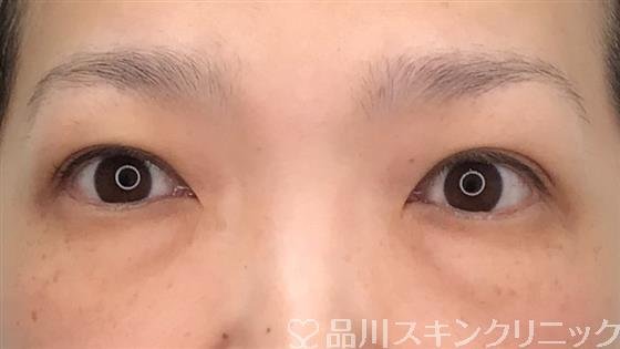 症例NO.54701のBEFORE写真