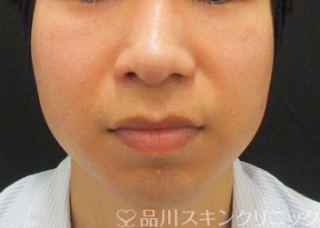 症例NO.65867のBEFORE写真