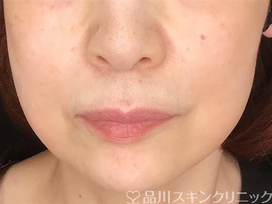 症例NO.61309のBEFORE写真