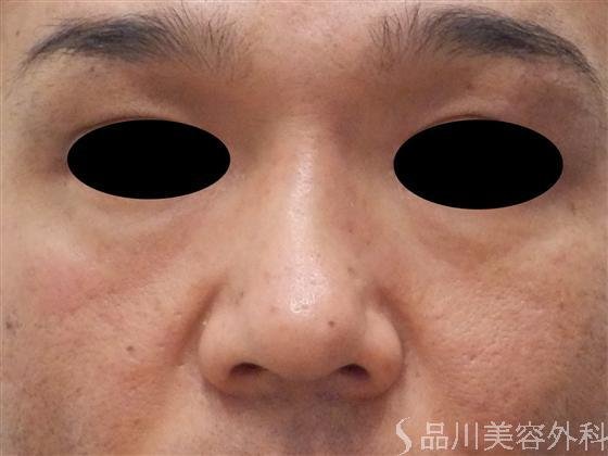 症例NO.15930のBEFORE写真