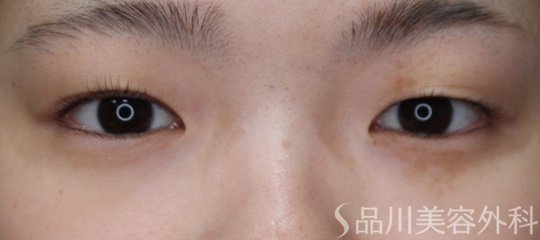 症例NO.67052のBEFORE写真