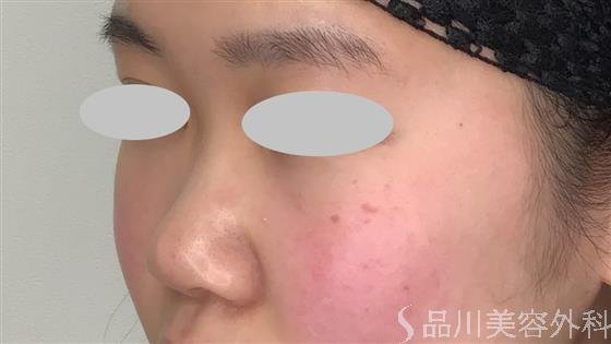 症例NO.60178のBEFORE写真