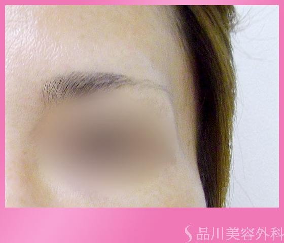 症例NO.1165のBEFORE写真