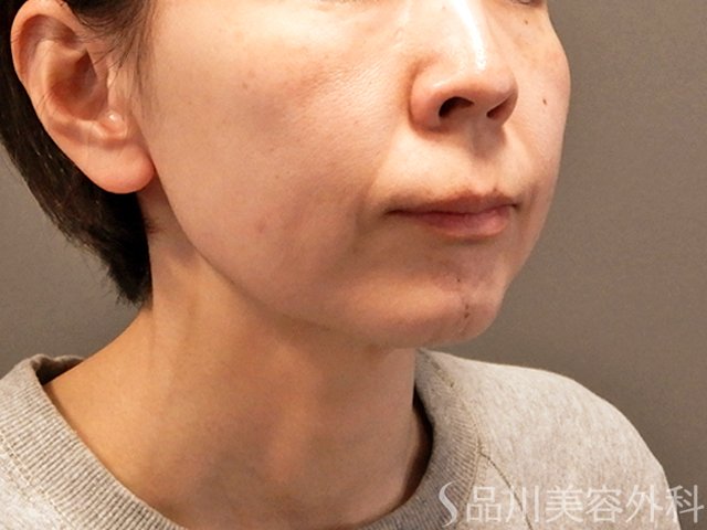 症例NO.68182のBEFORE写真