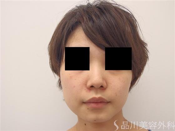 症例NO.6278のBEFORE写真