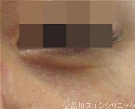 症例NO.30424のAFTER写真