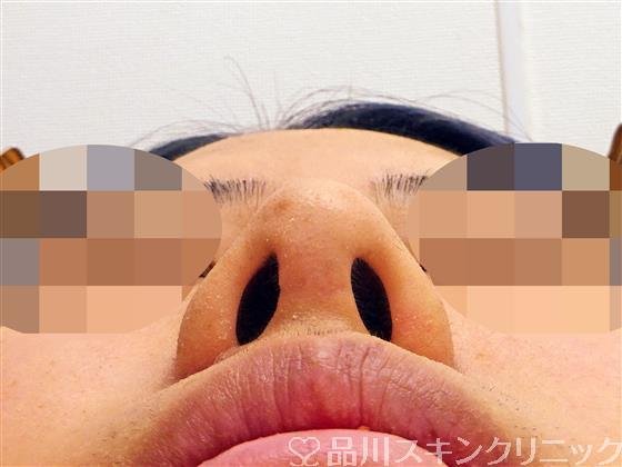 症例NO.45707のAFTER写真