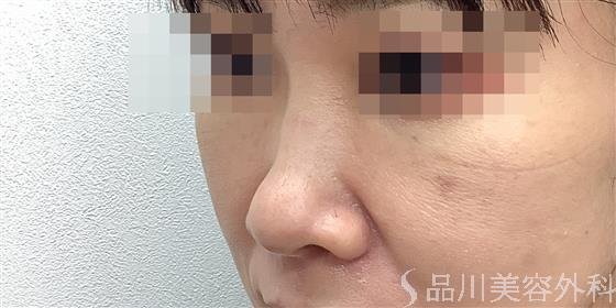 症例NO.57118のBEFORE写真