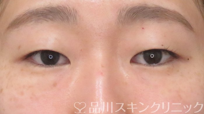 症例NO.68378のBEFORE写真