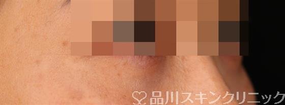 症例NO.53501のAFTER写真