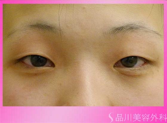 症例NO.42980のBEFORE写真