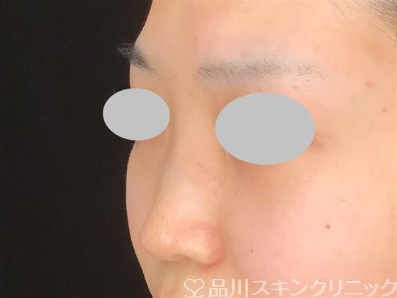 症例NO.60900のBEFORE写真