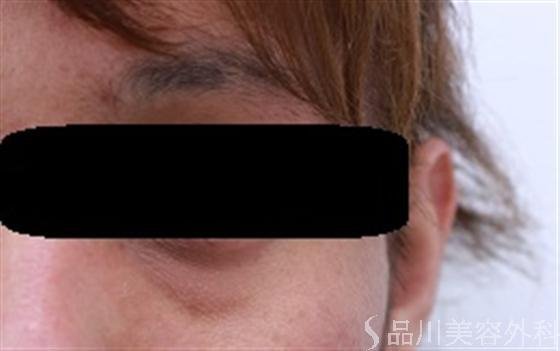 症例NO.17578のBEFORE写真