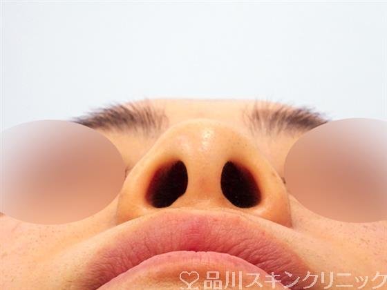 症例NO.49946のBEFORE写真