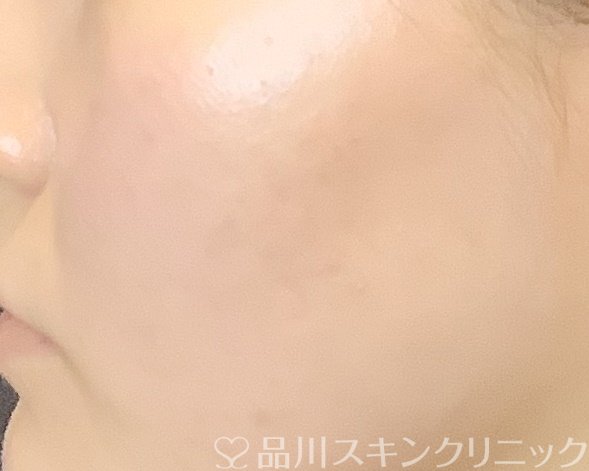 症例NO.66872のAFTER写真