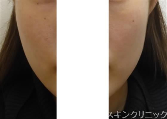 症例NO.32346のBEFORE写真