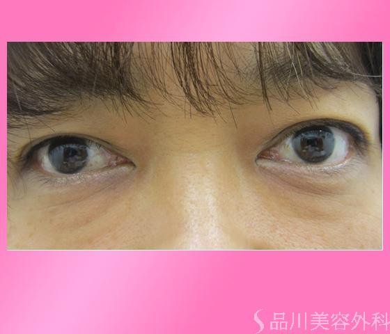 症例NO.2906のAFTER写真