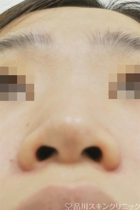 症例NO.29287のBEFORE写真