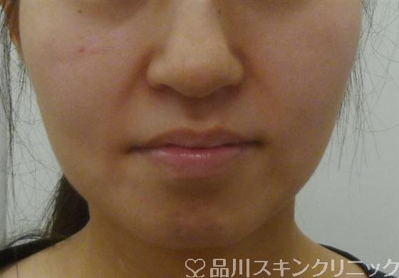 症例NO.40287のBEFORE写真