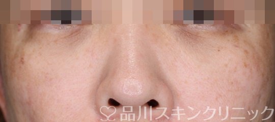 症例NO.65836のAFTER写真